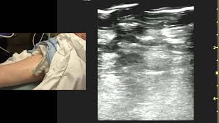 Ultrasound of the Popliteal Fossa [upl. by Jude]