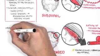 Intracranial Haemorrhage Types signs and symptoms [upl. by Enelak]