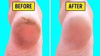 10 Natural Home Remedies for Silky Smooth Feet [upl. by Nolie207]