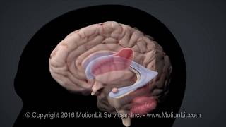 Intracerebral Hemorrhage Stroke [upl. by Aleta]