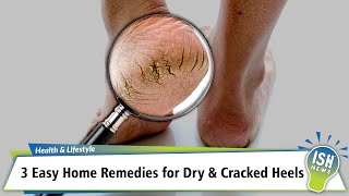 3 Easy Home Remedies for Dry amp Cracked Heels [upl. by Stinky800]