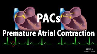 Premature Atrial Contractions PACs Animation [upl. by Yerag156]